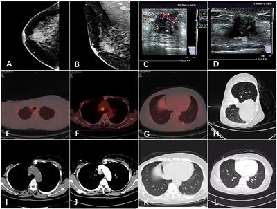 Frontiers Primary Squamous Cell Carcinoma Of The Breast A Case